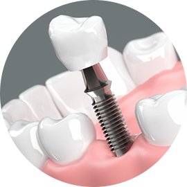 インプラント治療